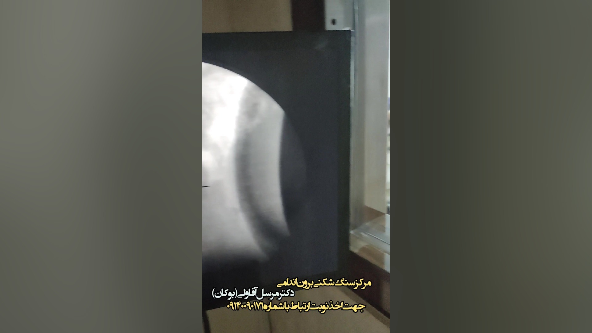 شکستن سنگ کلیه ۱۲ میلی با لیزر در بوکان ۰۹۱۴۰۰۹۰۱۷۱ پالپوتومی