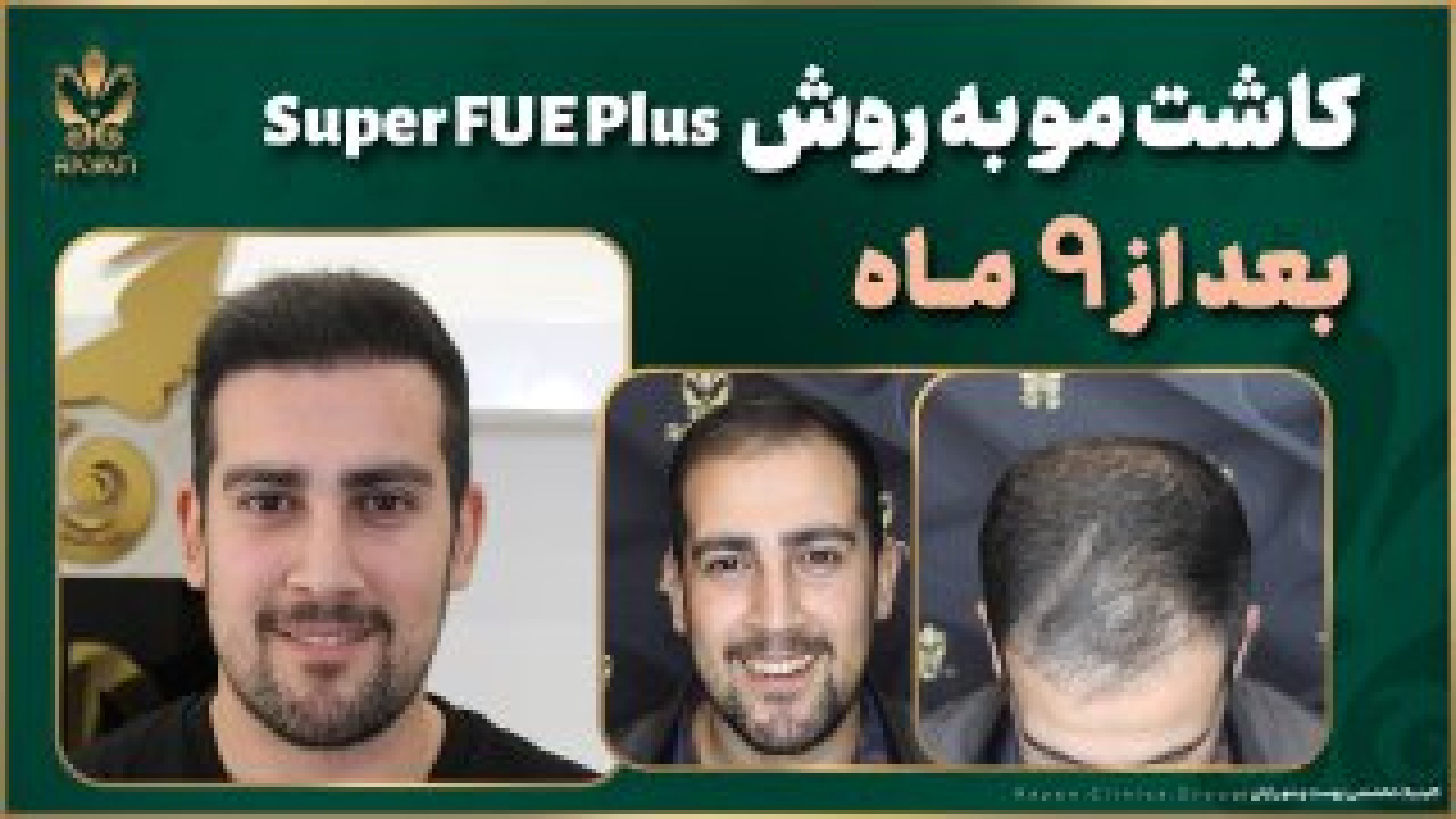 کاشت مو به روش Super FUEPlus در کلینیک رایان جراحی پف زیر چشم