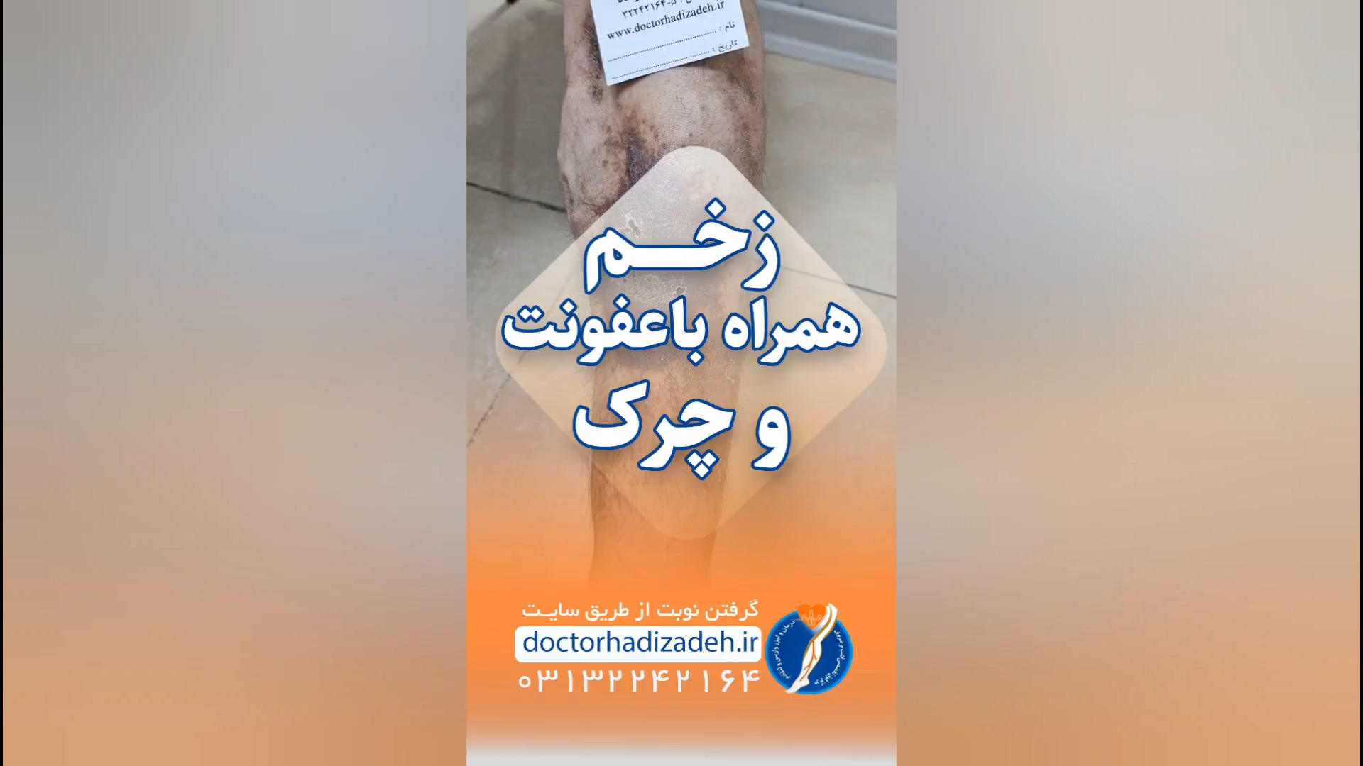 زخم عفونی ناشی از واریس شدید! مینی سریال