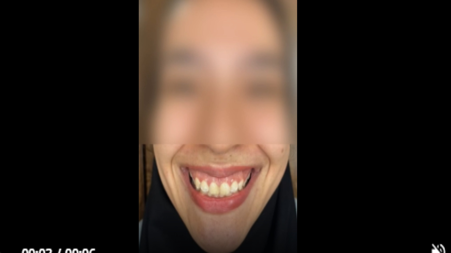 بوتاکس لبخند لثه ای دکتر صدیقه نائیجی | متخصص پوست و مو در قم