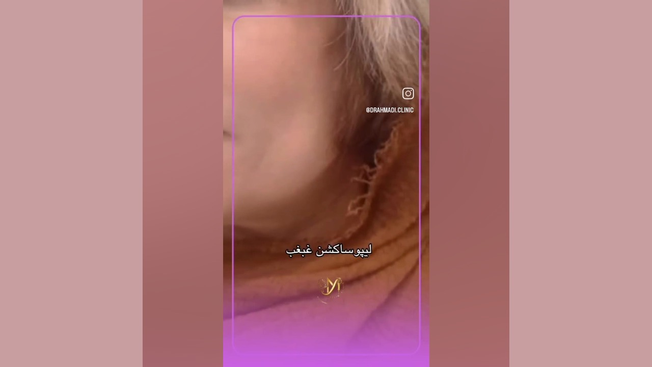 لیپوساکشن غبغب در شیراز بیماری آمیلوئیدوز فامیلیال