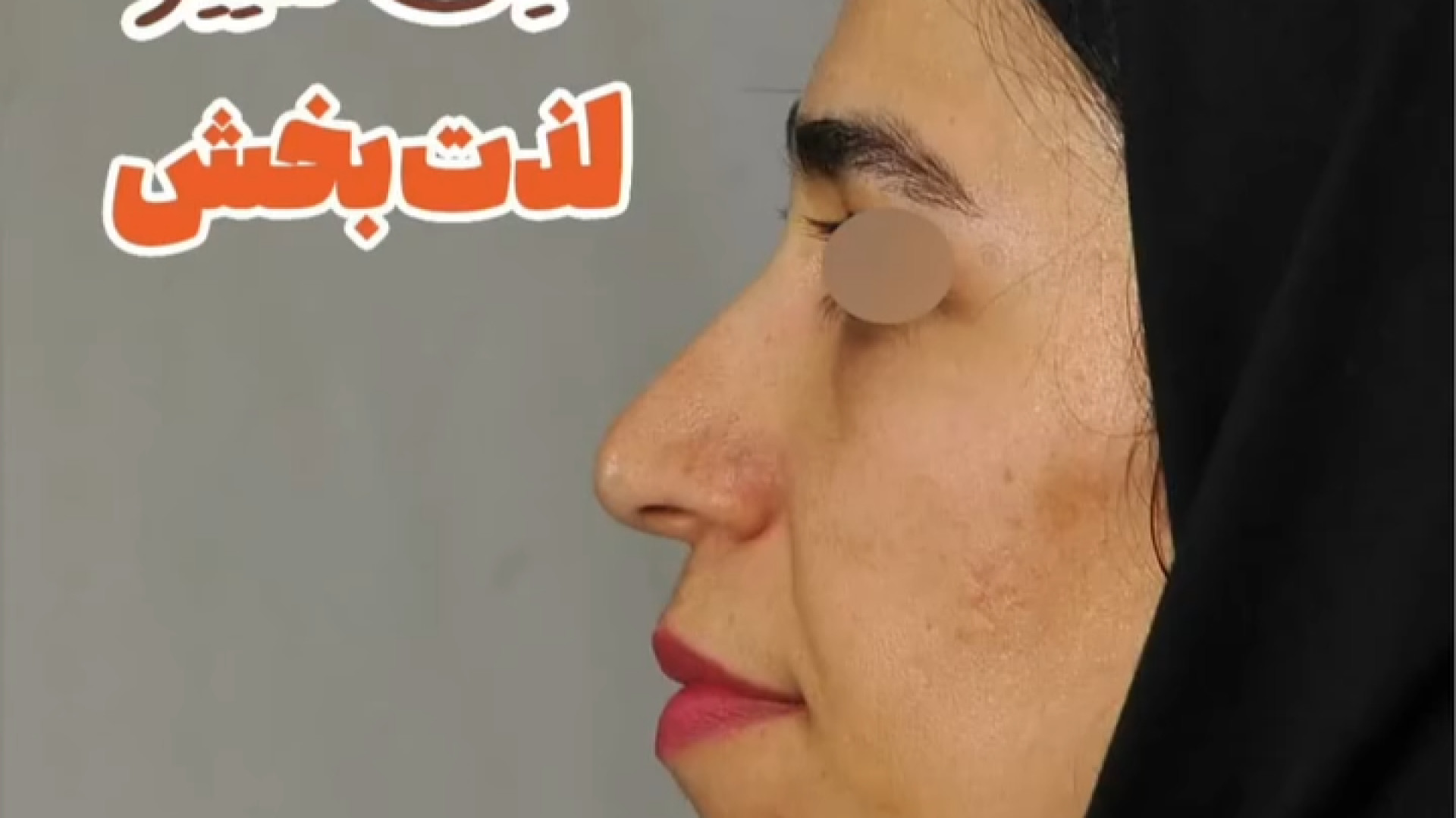 جراحی زیبایی بینی | دکتر مومنی پلاسماجت