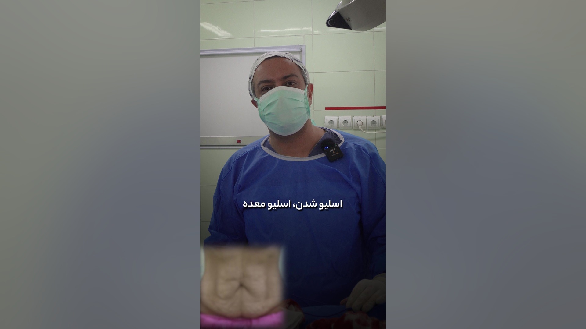 تنها راه خلاص شدن از پوست شکم بعد از اسلیو معده دکتر سعید مرادی