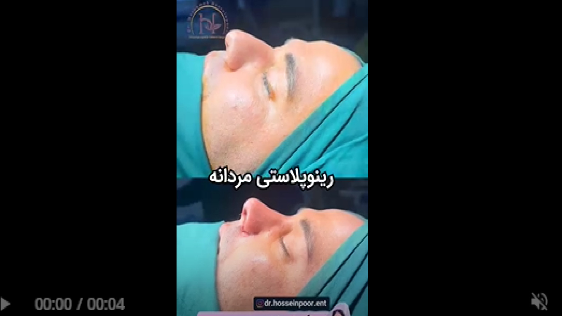 جراحی زیبایی بینی مردانه دکتر معصومه حسین پور