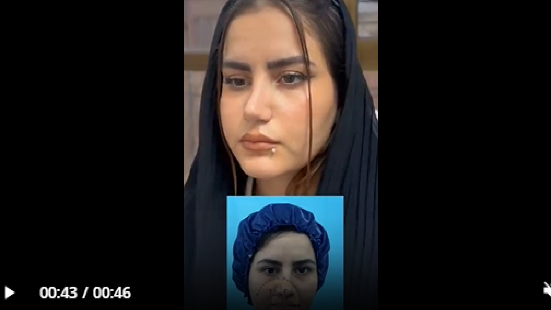 سه ماه بعد از عمل بینی دکتر معصومه حسین پور