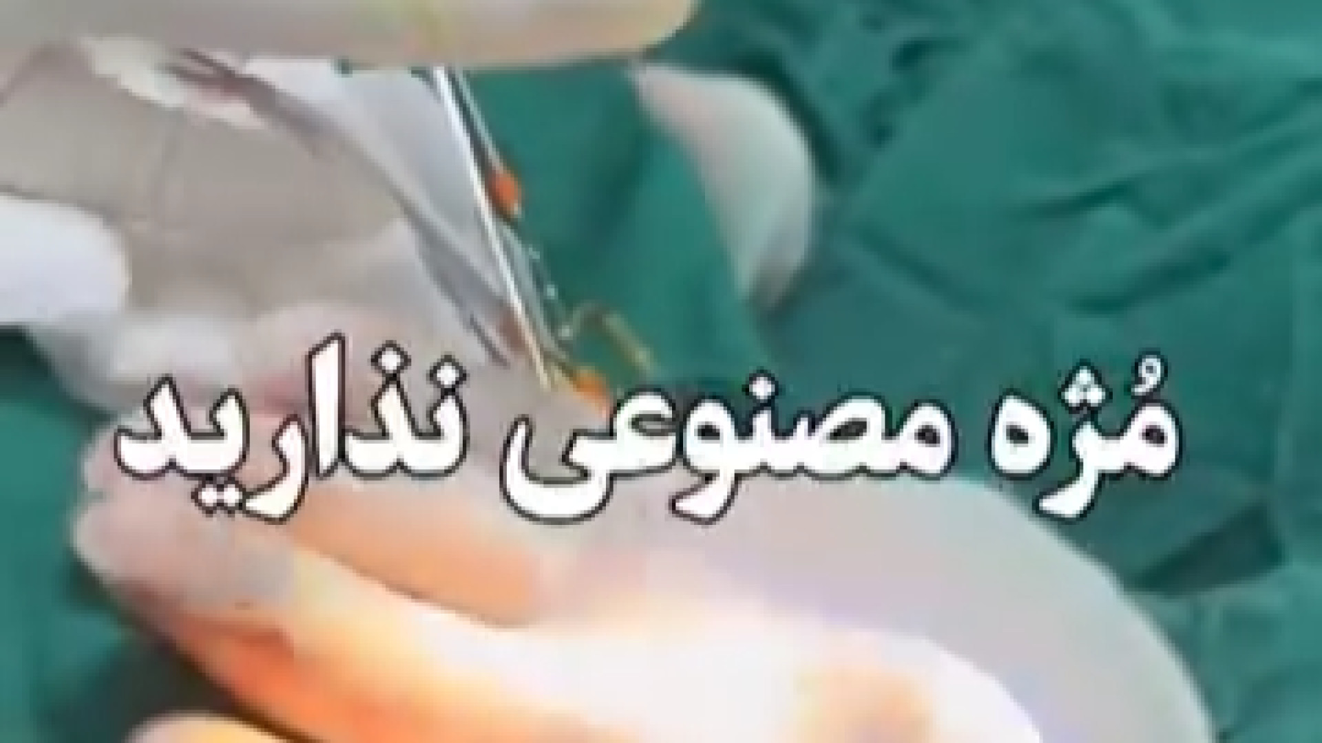 کاشت مژه حین عمل بینی دکتر معصومه حسین پور