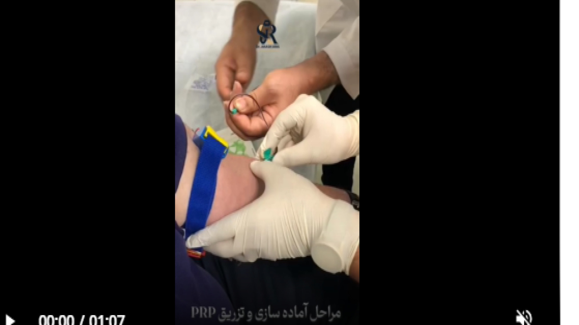 مراحل آماده سازی و تزریق PRP دکتر آرش اریس