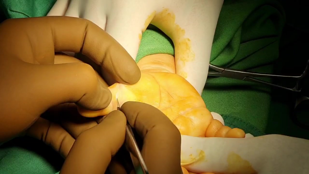 جراحی درمان بیماری مادرزادی انگشت ماشه ای کلیپ