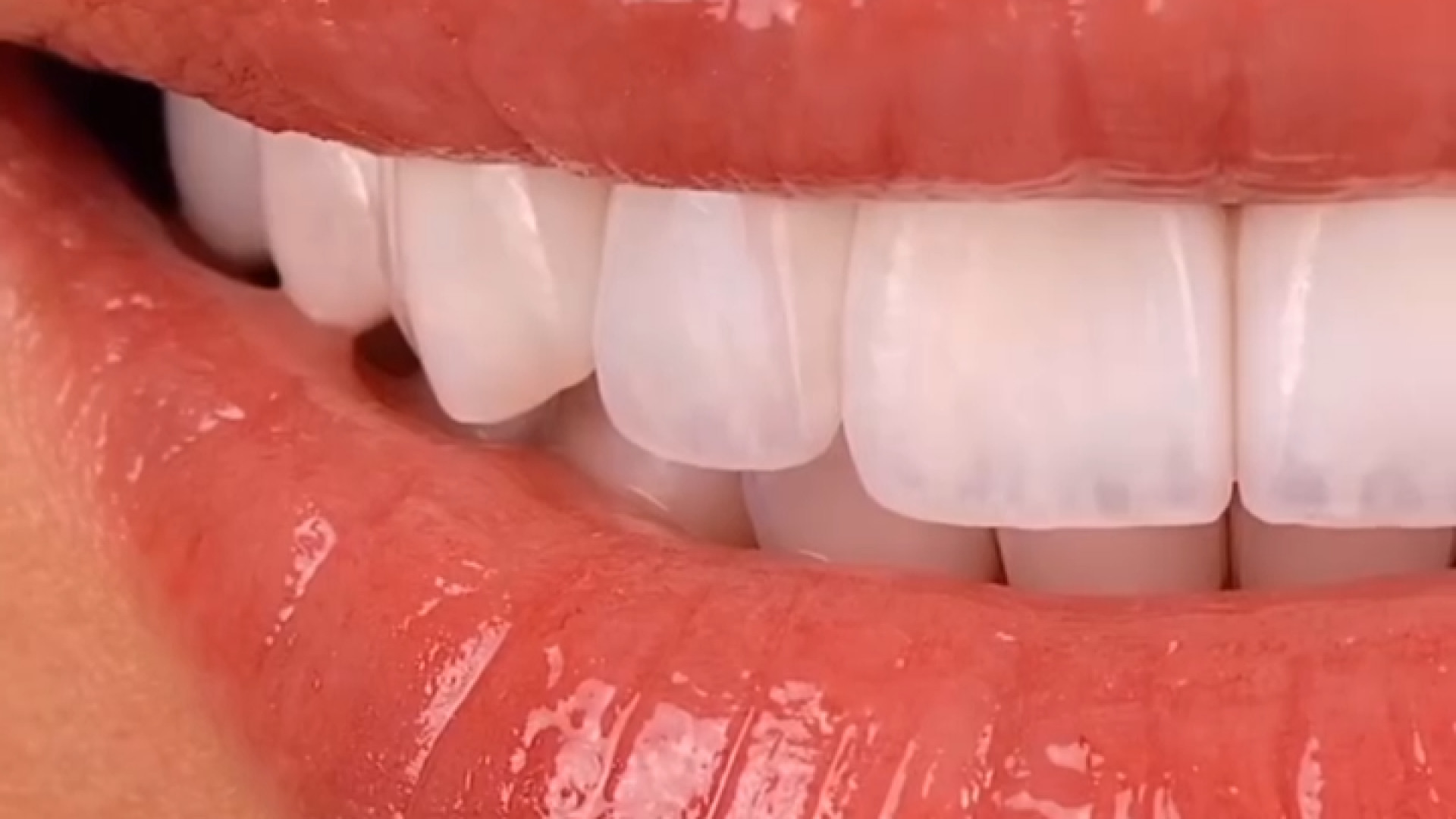 نمونه کار کامپوزیت دندان دکتر ندا هادی-دندانپزشک زیبایی