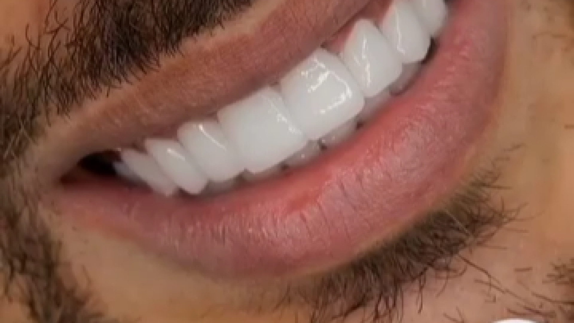 نمونه کار اصلاح طرح لبخند دکتر ندا هادی-دندانپزشک زیبایی