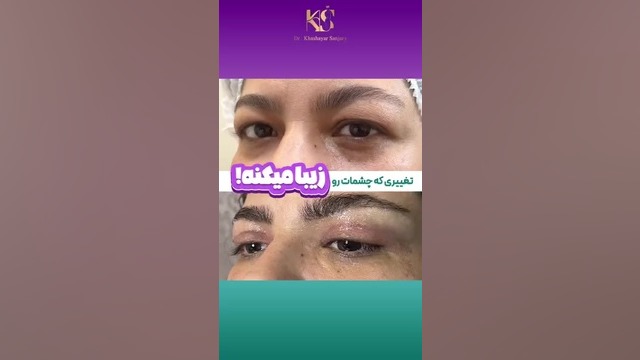 تغییری که چشمات رو زیبا می کنه دکتر خشایار سنجری متخصص جراحی جنرال و زیبایی