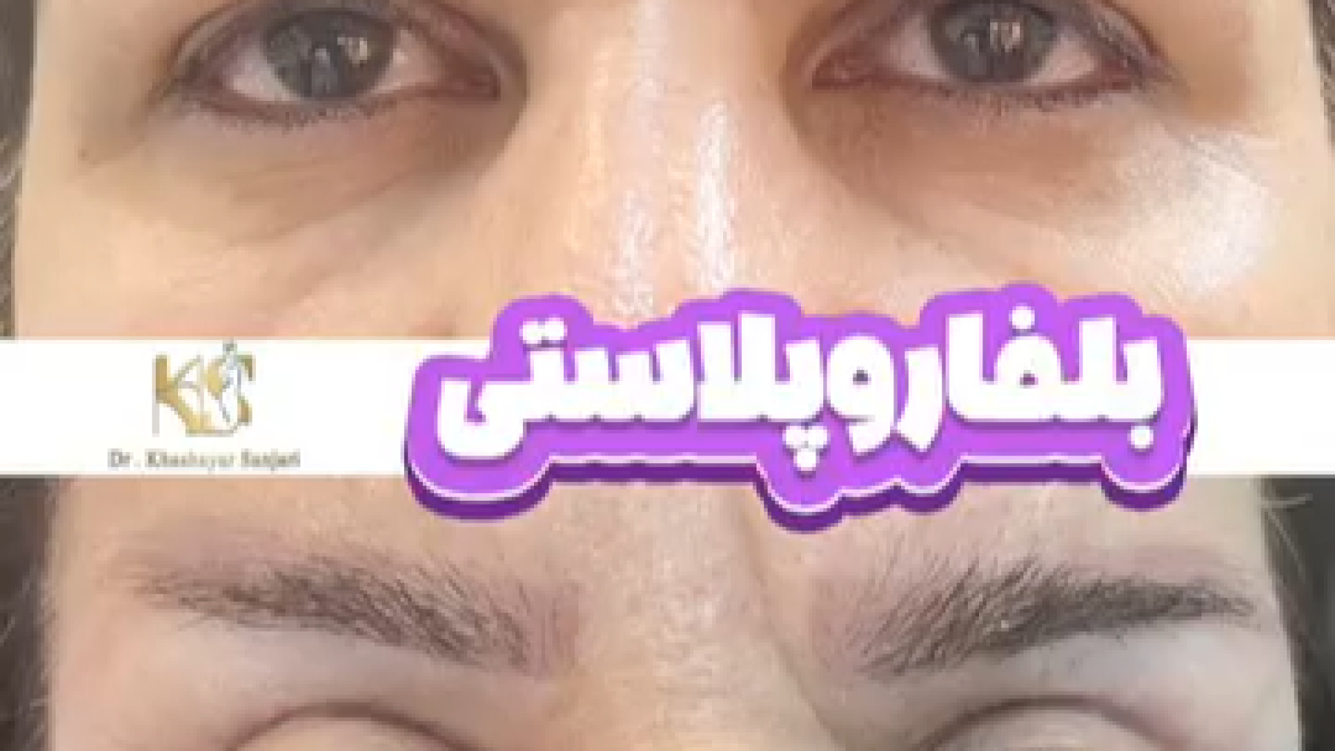 عمل بلفاروپلاستی با دکتر خشایار سنجری دکتر خشایار سنجری متخصص جراحی جنرال و زیبایی