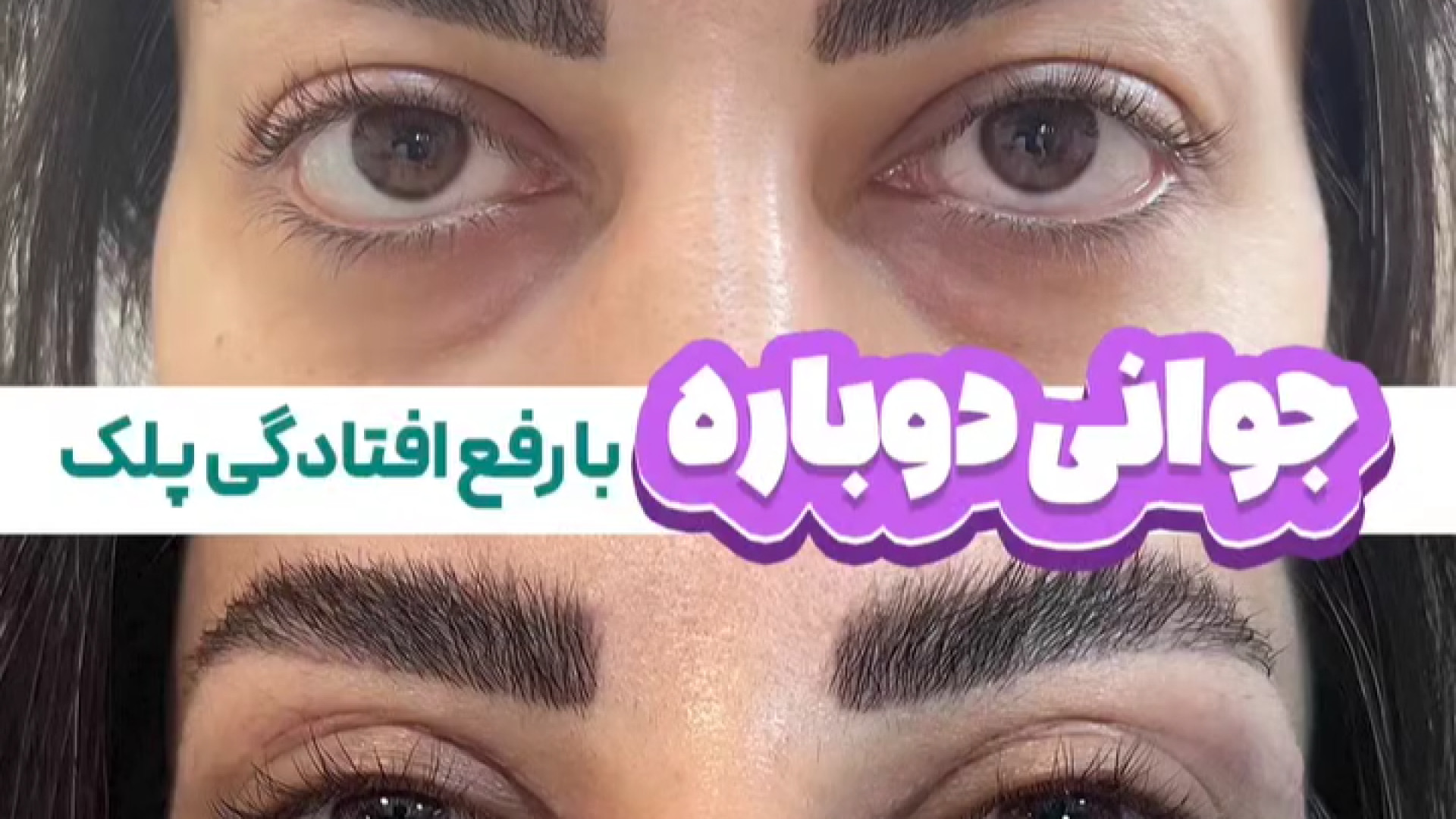 جوانی دوباره با رفع افتادگی پلک توسط دکتر خشایار سنجری Ribo-Seq
