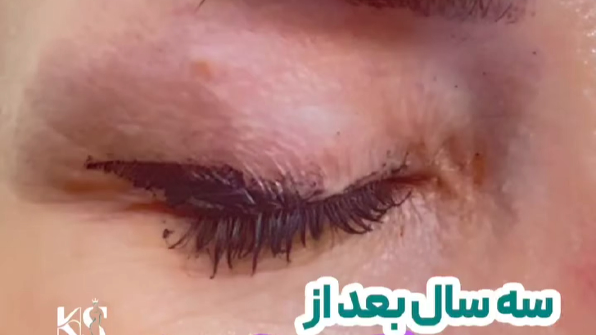 3 سال بعد از بلفاروپلاستی توسط دکتر خشایار سنجری دکتر خشایار سنجری متخصص جراحی جنرال و زیبایی