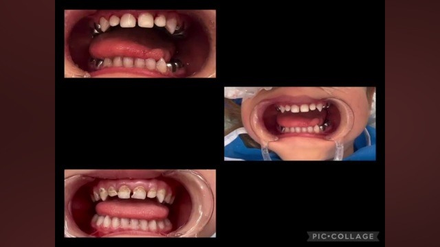 دندانپزشکی کودکان با بیهوشی کامل در اصفهان | دکتر ساناز طهمورث پور مهندسی ژنوم انسانی