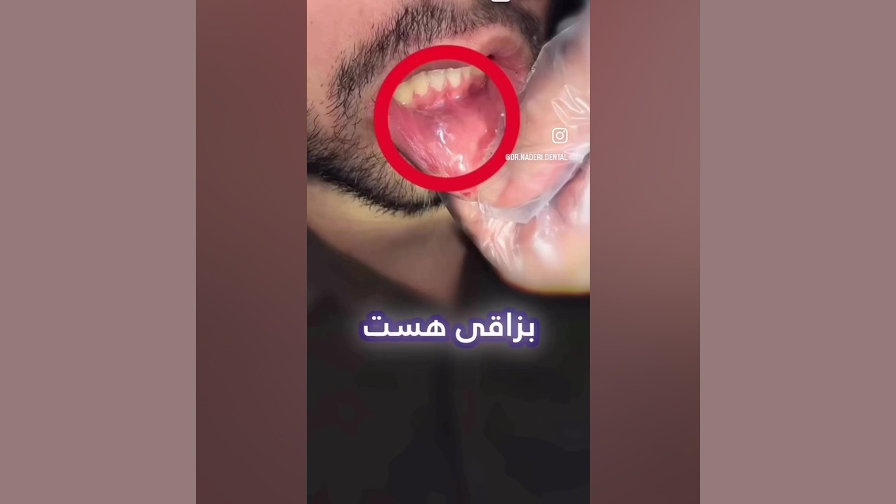 موکوسل دهان و لب دکتر علی اصغر نادری
