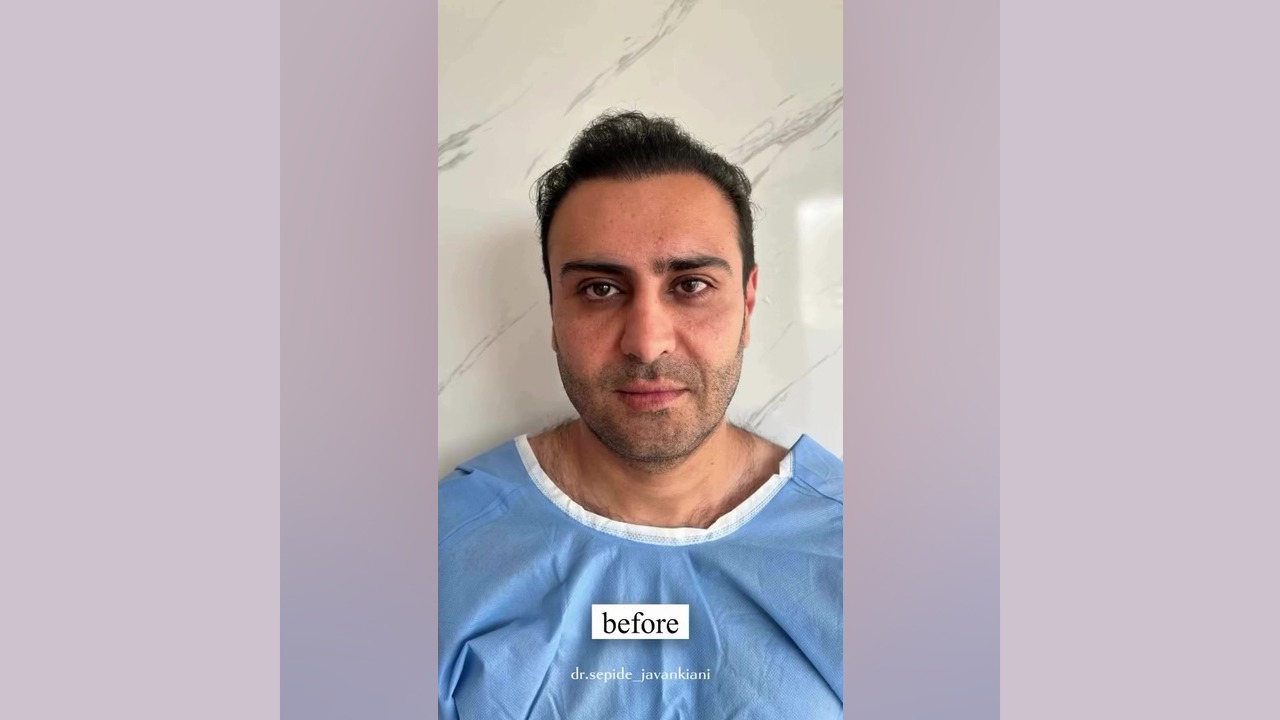 آتیوا: روش بدون درد و عارضه برای جوان‌سازی و لیفت پوست! کلونیک اسپاسم
