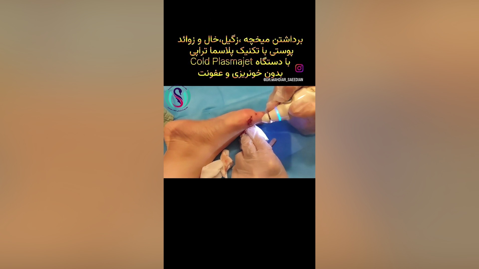 پلاسما تراپی: تحولی در پزشکی ترمیمی و زیبایی کربوکسی تراپی