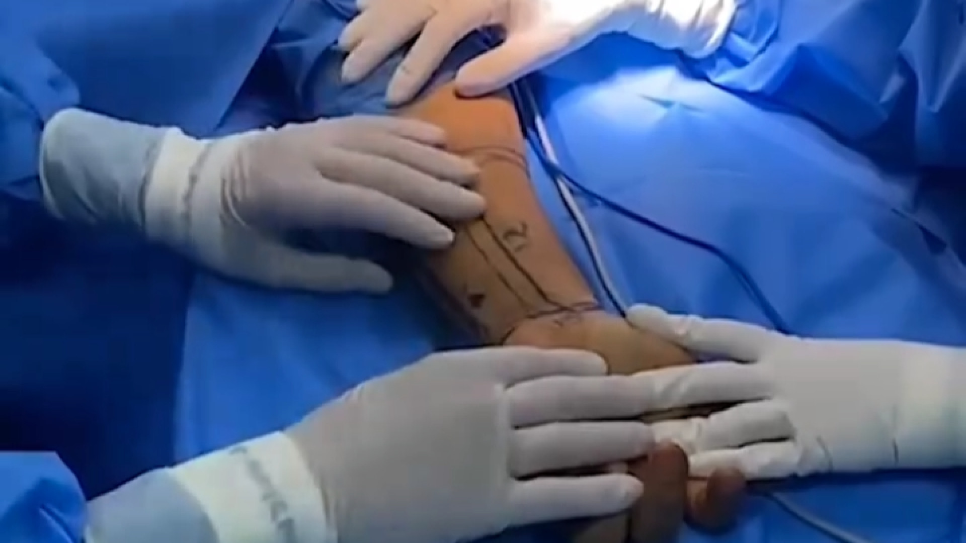جراحی فالوپلاستی از ساعد دکتر محمدرضا آخوندی نسب-فوق تخصص جراحی پلاستیک