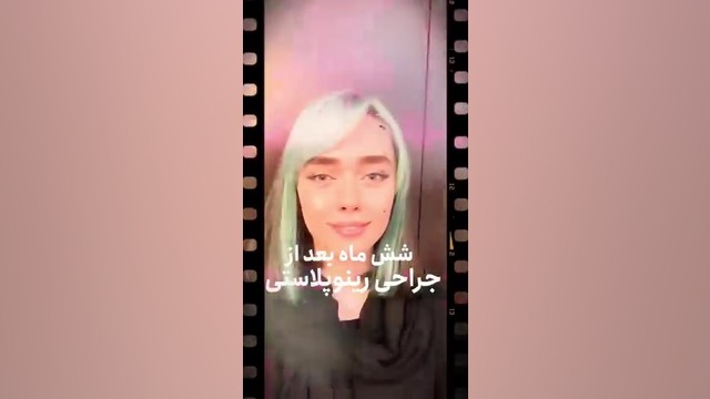 شش ماه بعد از رینوپلاستی دکتر شاهین بهجو - فوق تخصص جراحی پلاستیک