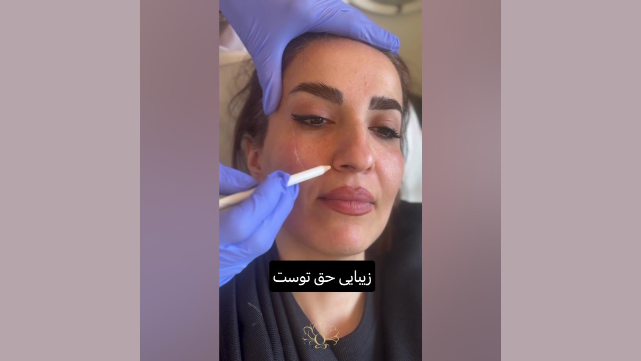 کانتورینگ (زاویه سازی) صورت با تزریق ژل ساکوبیتریل