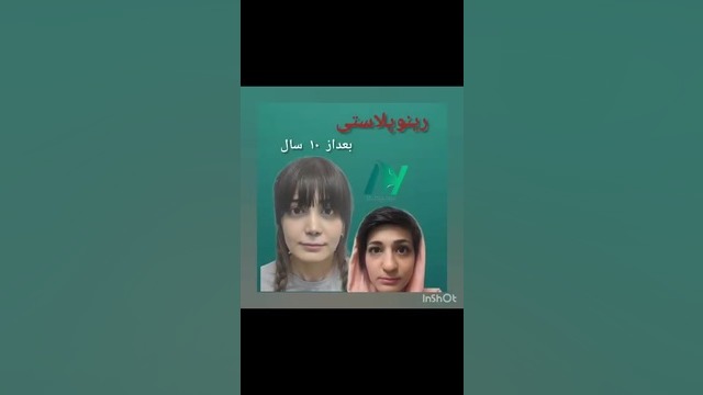 قبل و بعد عمل بینی دکتر محمودرضا اصحاب یمین - فوق تخصص پلاستیک