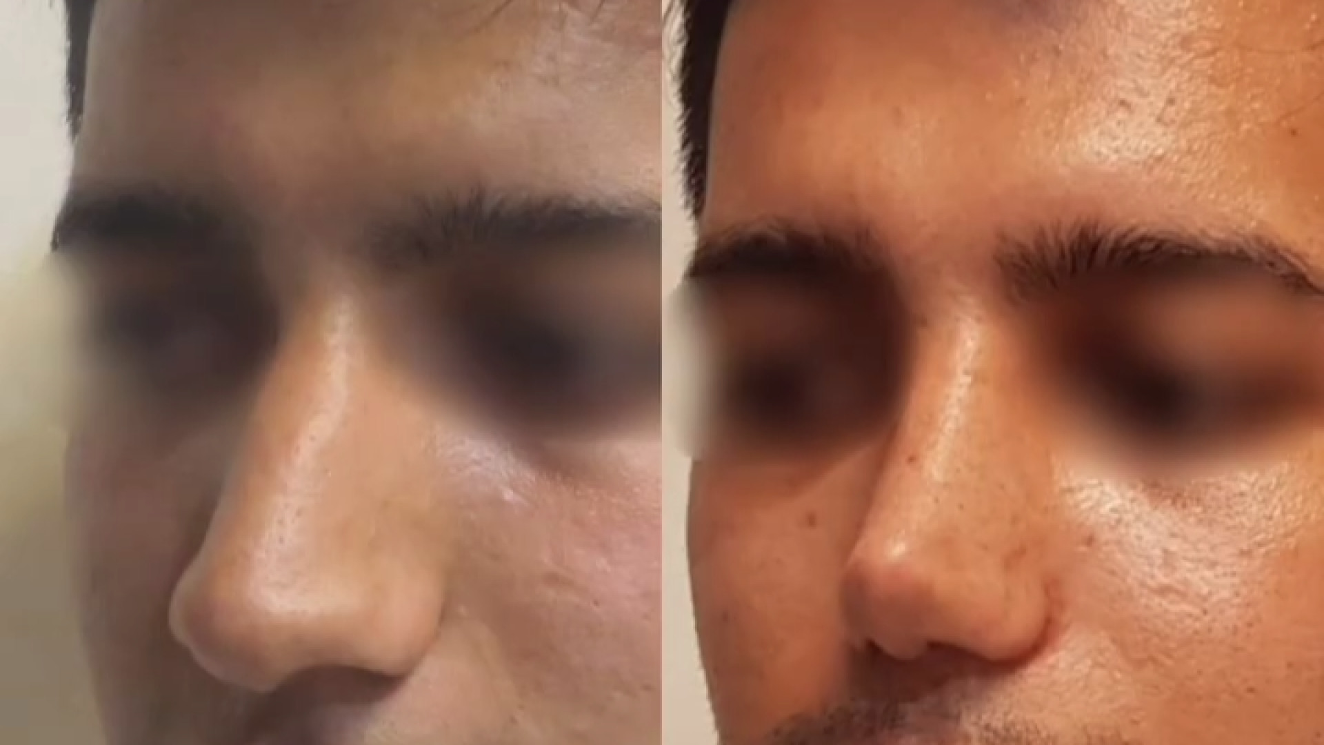 رینوپلاستی مردانه دکتر محمودرضا اصحاب یمین - فوق تخصص پلاستیک