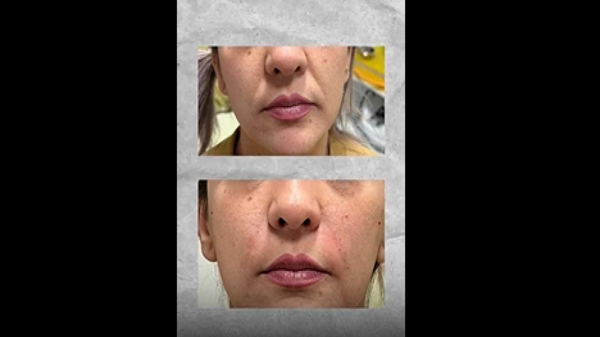 تزریق فیلر خط لبخند دکتر سار ا لطفی