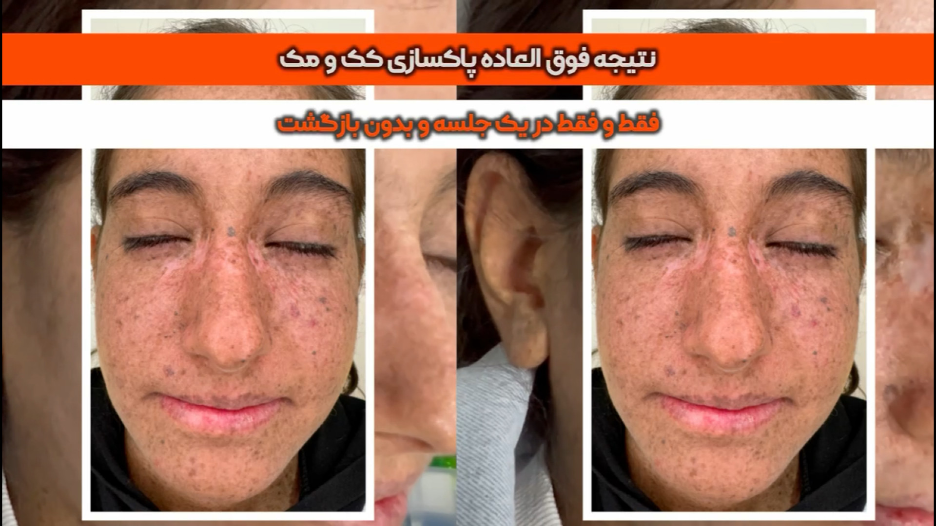 پاکسازی تخصصی کک و مک ، خال و زوائد کلینیک آفتاب هیدروپس فتالیس