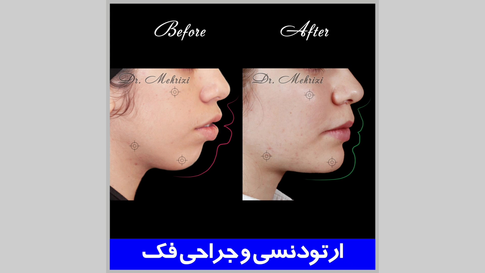 ارتودنسی و جراحی فک سندرم هرمون گیرنده مقاوم