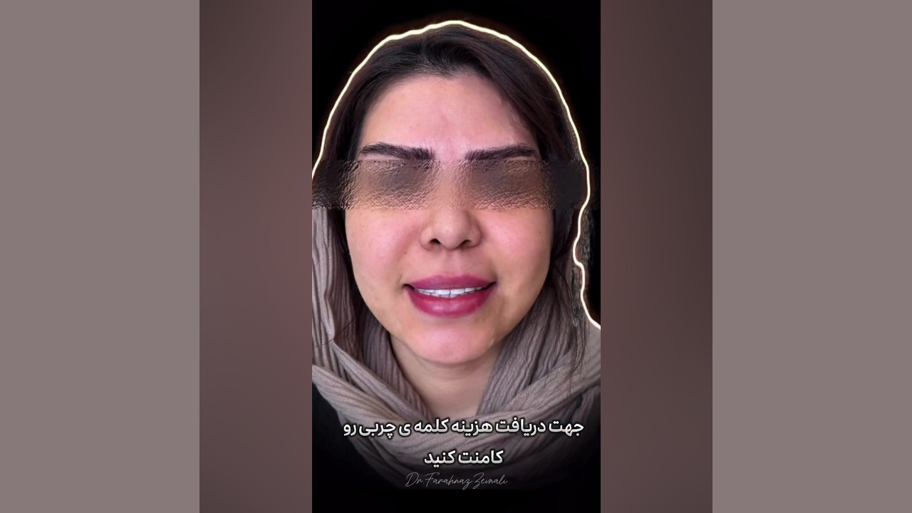 نتیجه قبل و بعد تزریق چربی به صورت دکتر فرحناز زینعلی - متخصص پوست، مو، زیبایی زنجان