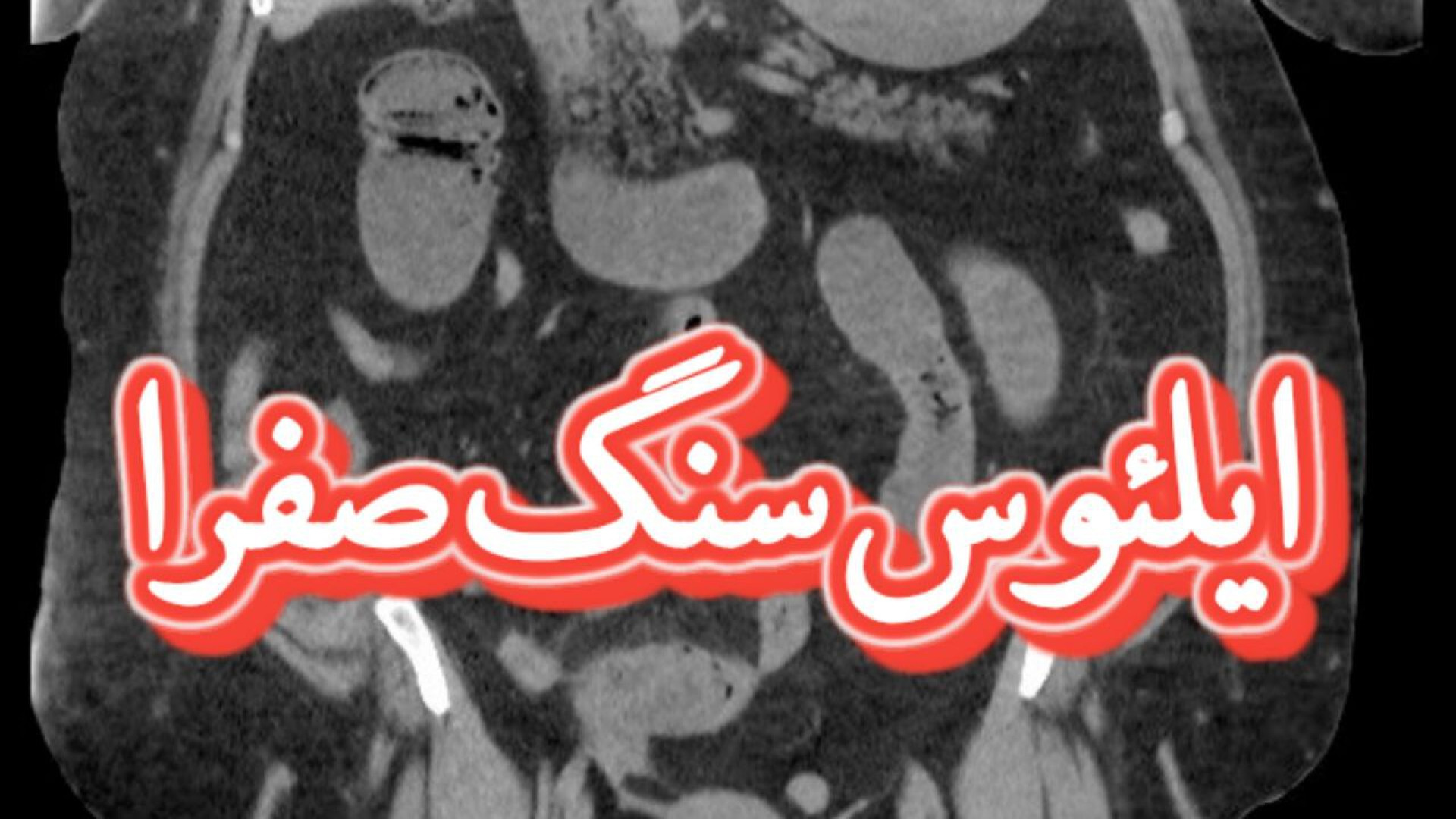 4 یافته ی مهم در ایلئوس سنگ صفرا و سی تی اسکن جوانسازی پوست