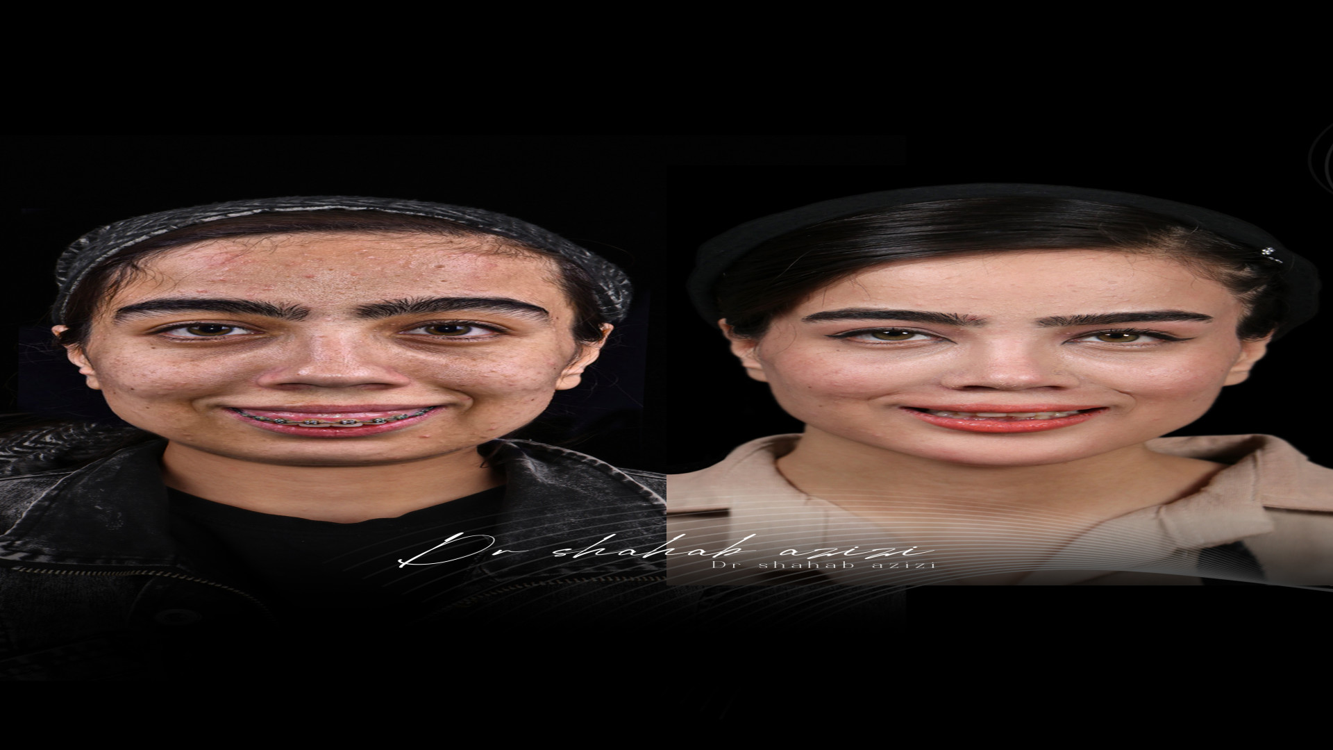 جراحی فک و بینی لیزر موهای زائد