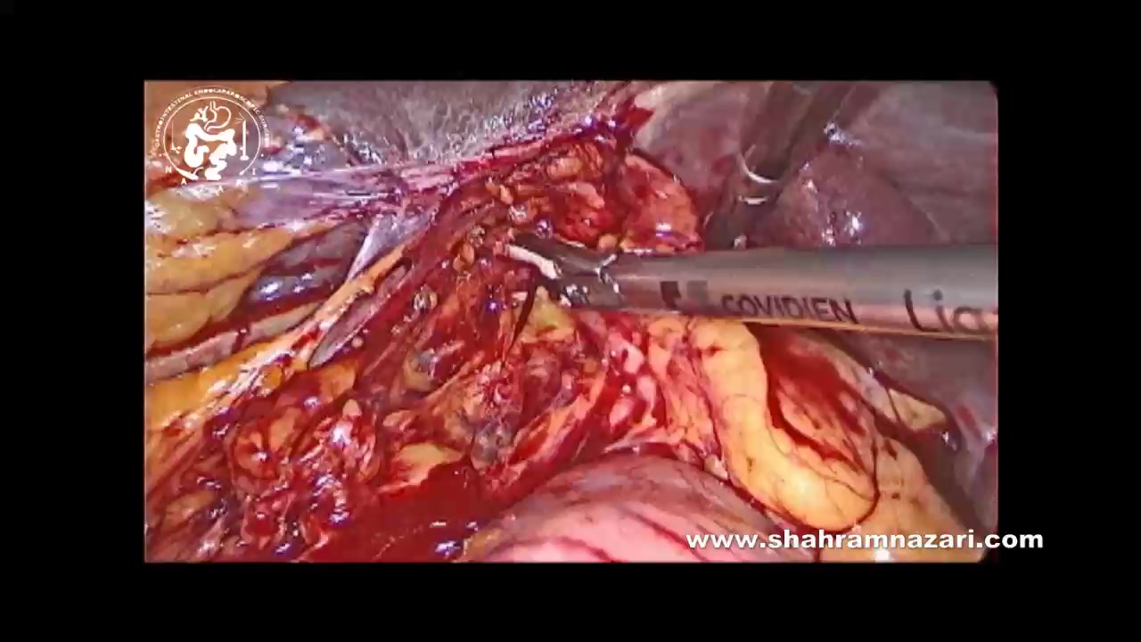 سندرم میریزی در عمل کیسه صفرا جاستین بیبر