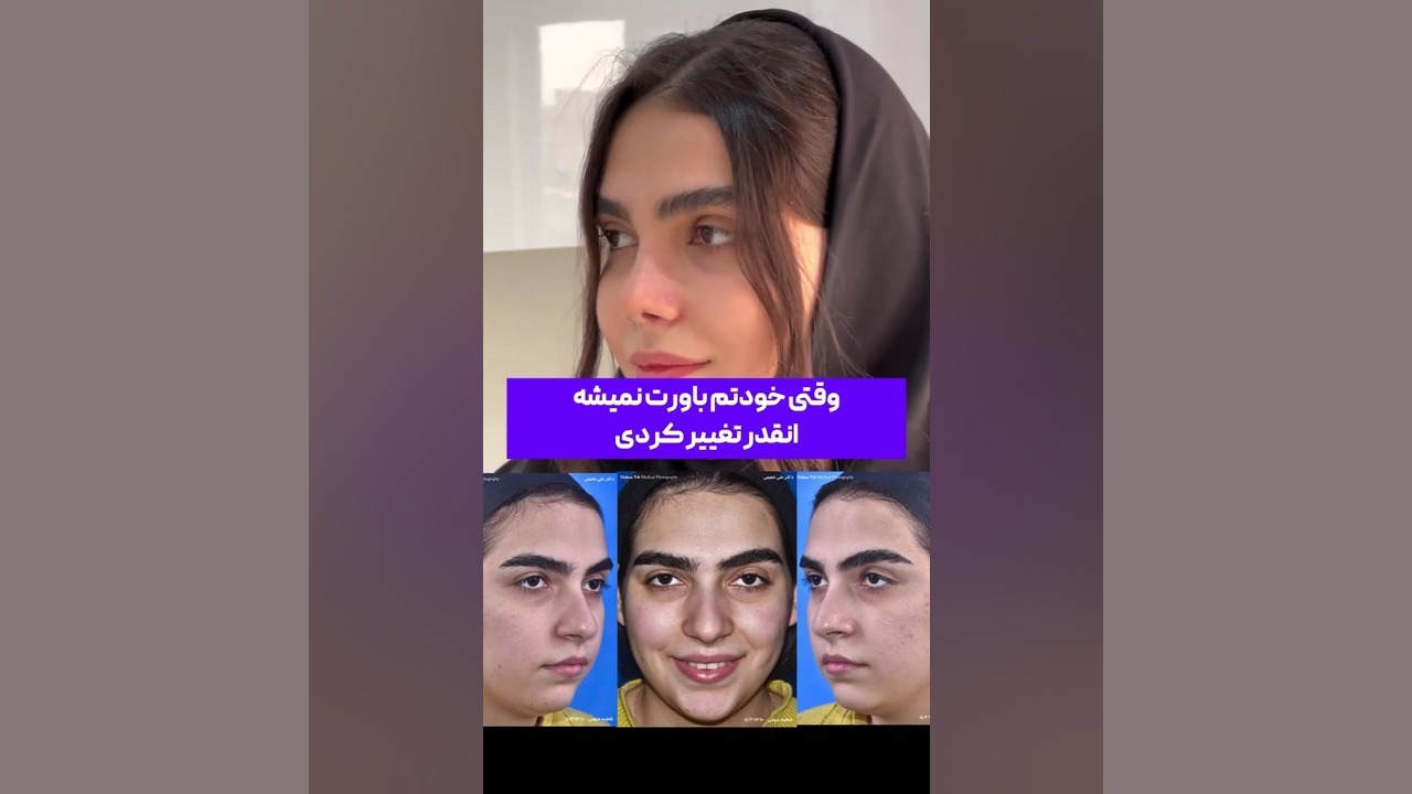 عمل بینی دخترانه در تهران دکتر علی شفیعی رونیزی | بهترین جراح بینی تهران
