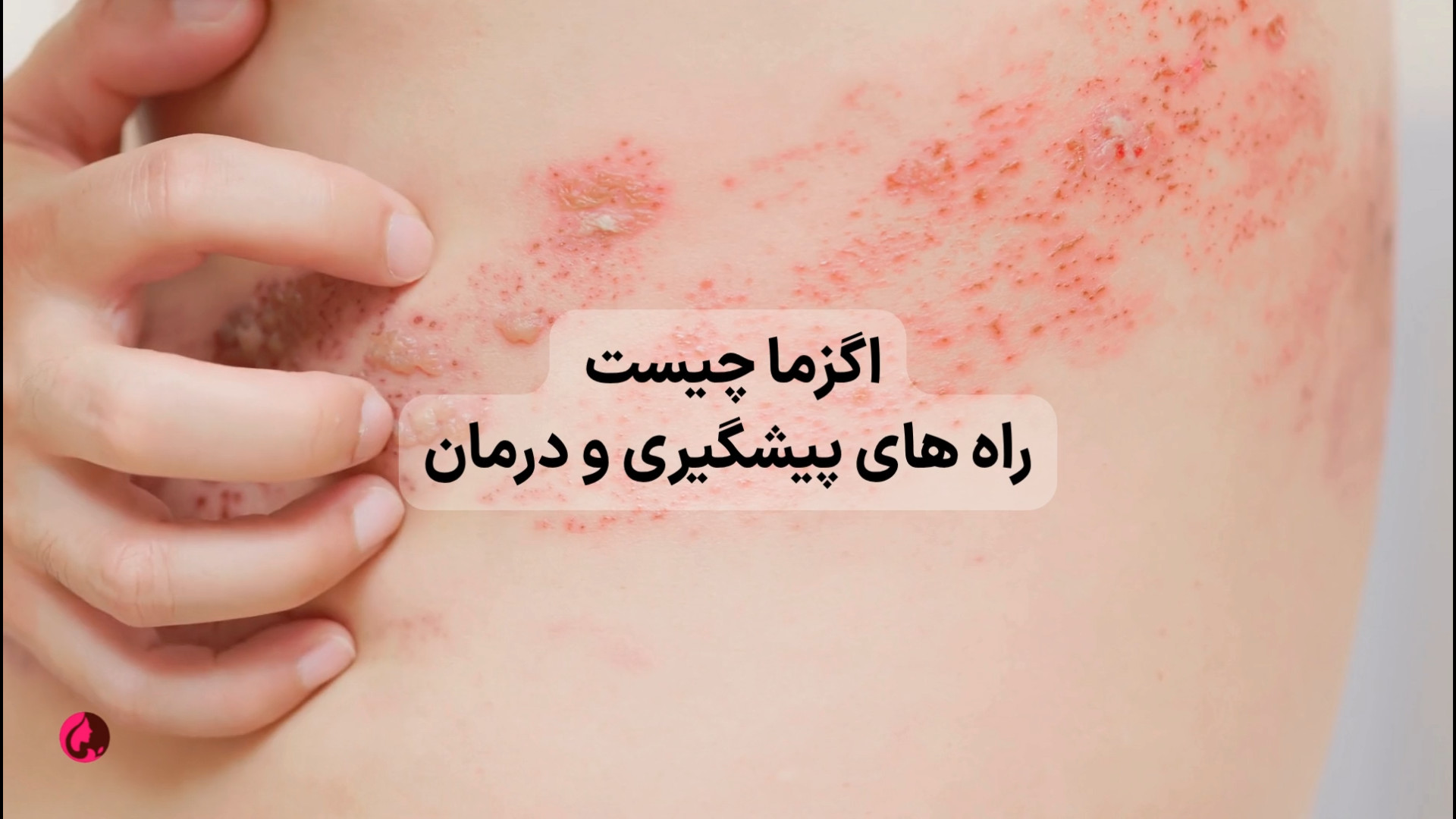 اگزما چیست؟ - راه‌های پیشگیری و درمان فیلم کوتاه