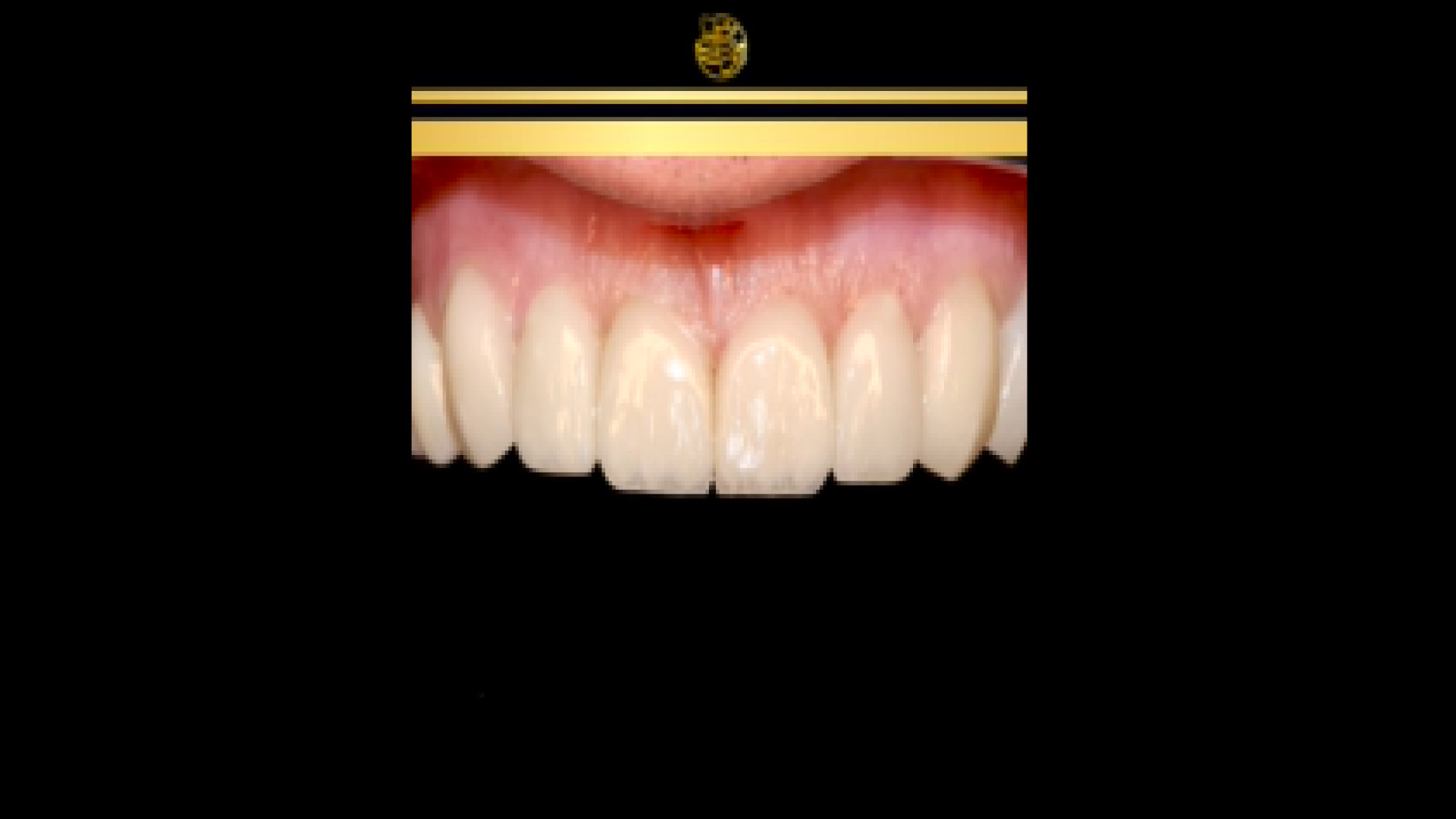 اصلاح لبخند طبیعی الکترود اپتوژنزی