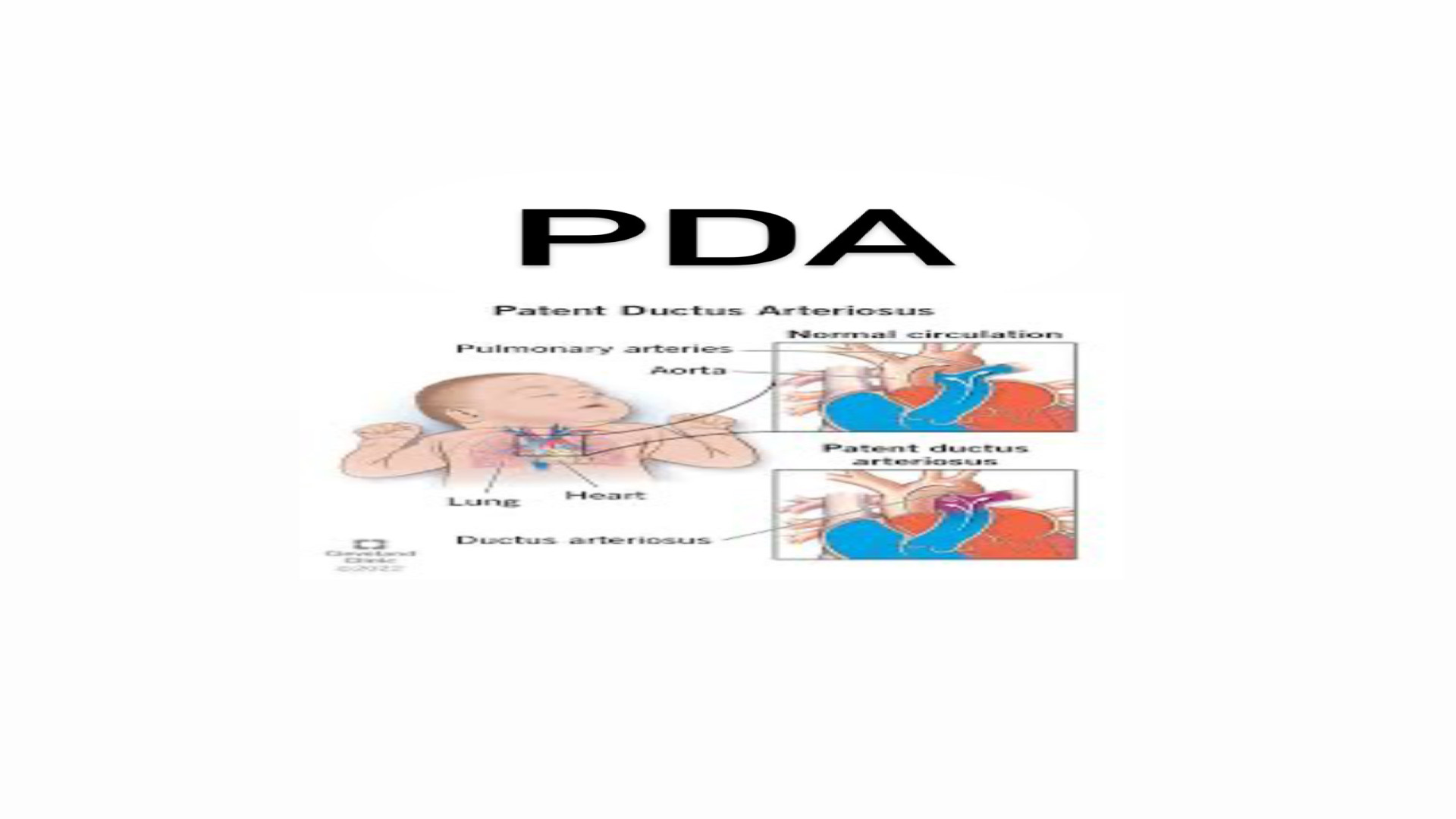 بيماري مادرزادي قلب_پي دي ا PDA لیونل مسی