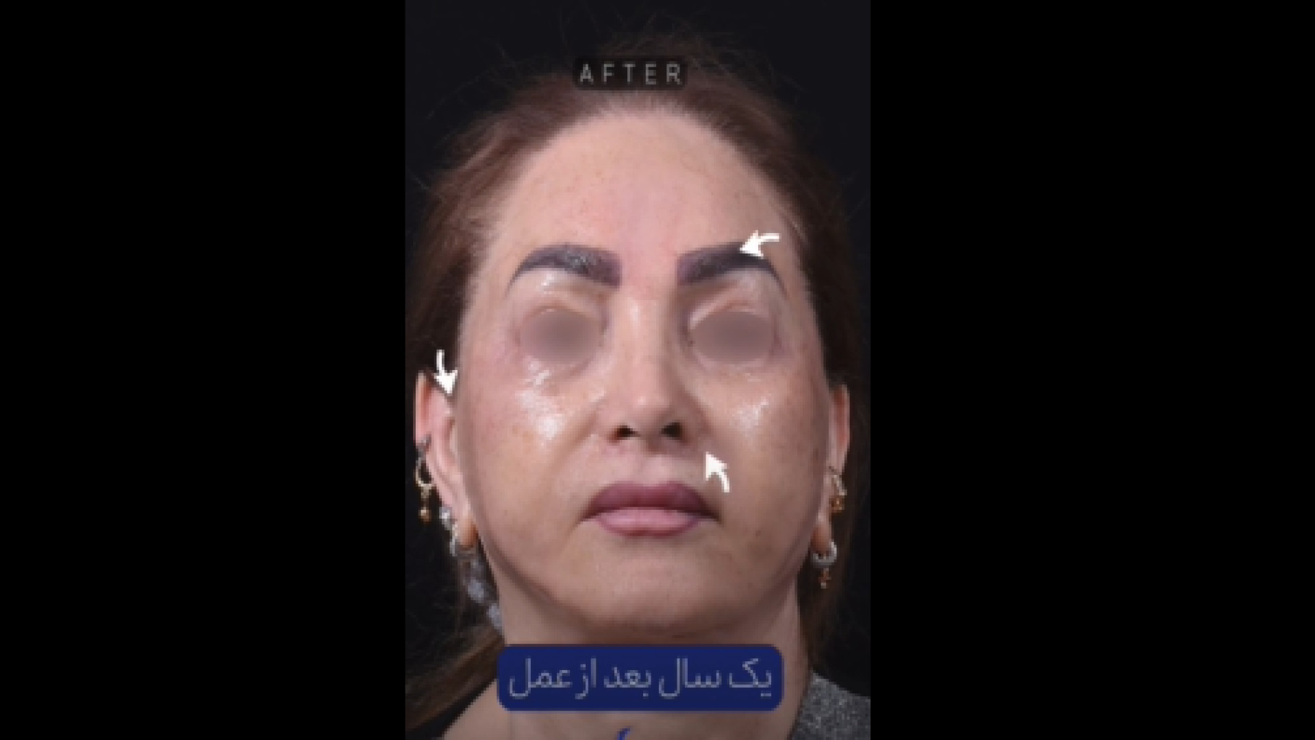 نتیجه عمل ترکیبی سانترال لب و لیفت صورت دکتر حمید رضا فتحی فوق تخصص جراحی پلاستیک