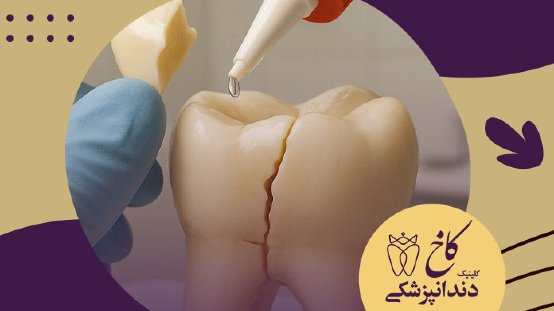 چسب دندون؟ کلینیک دندانپزشکی کاخ