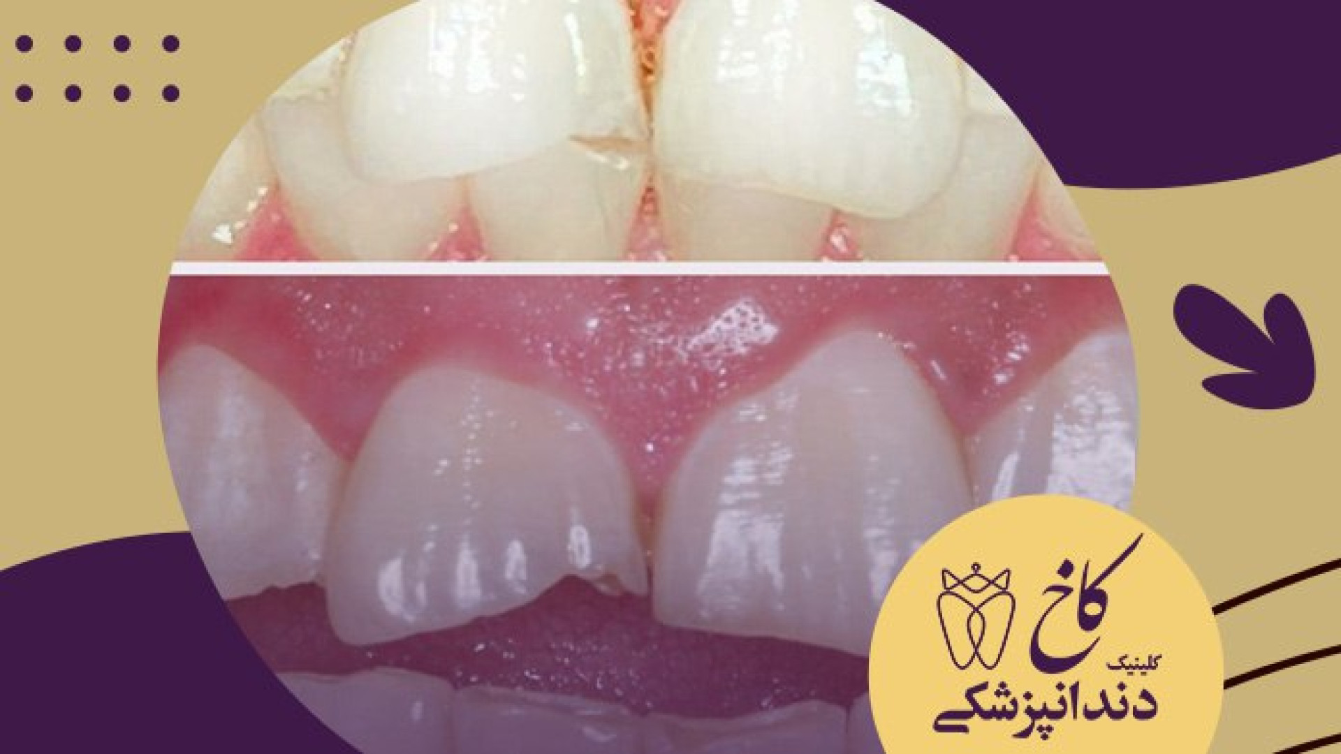 لیفت لثه با لیزر کلینیک دندانپزشکی کاخ