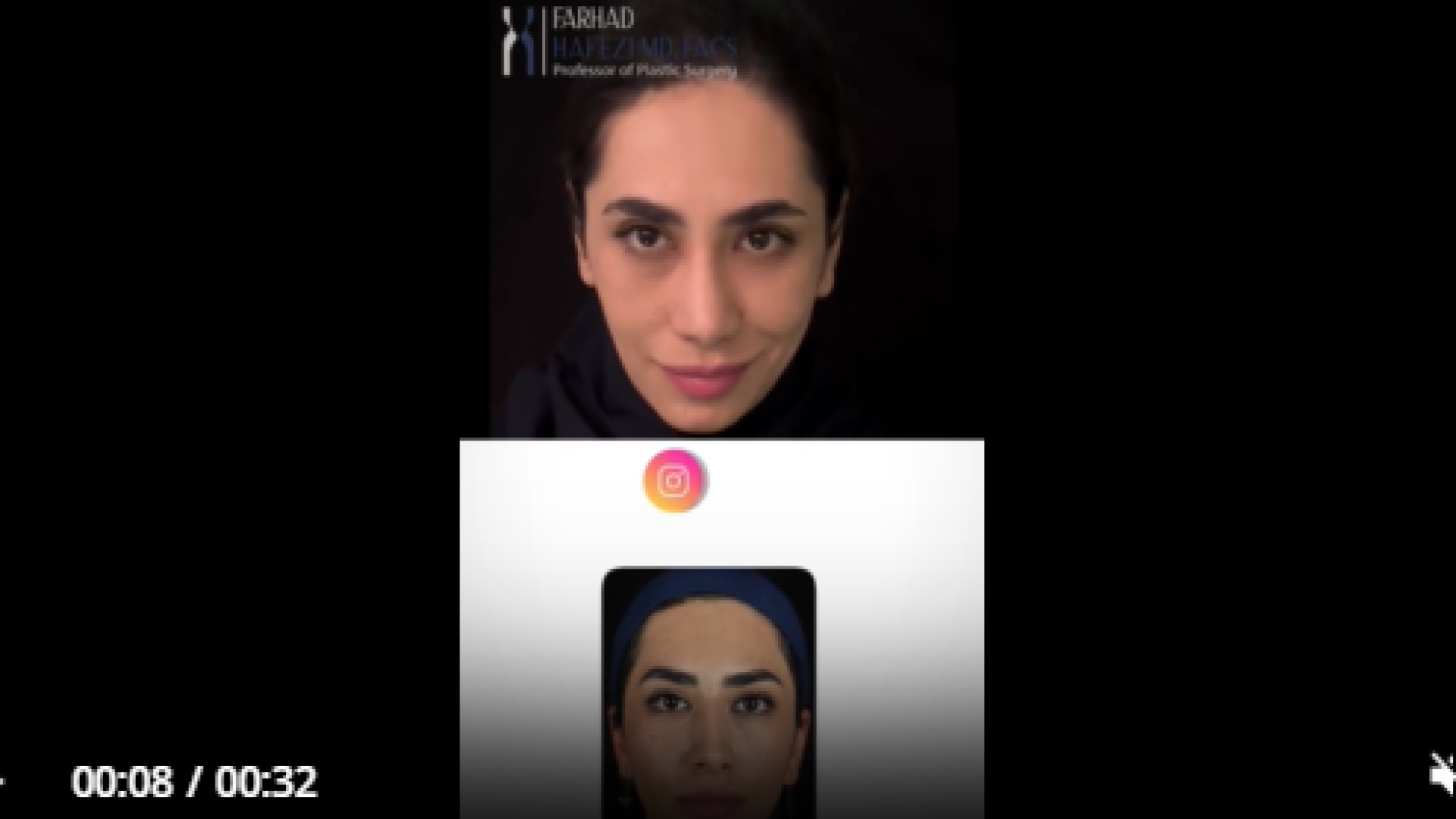 رینوپلاستی و تزریق چربی به گونه ها و چانه بعد 5 سال دکتر فرهاد حافظی