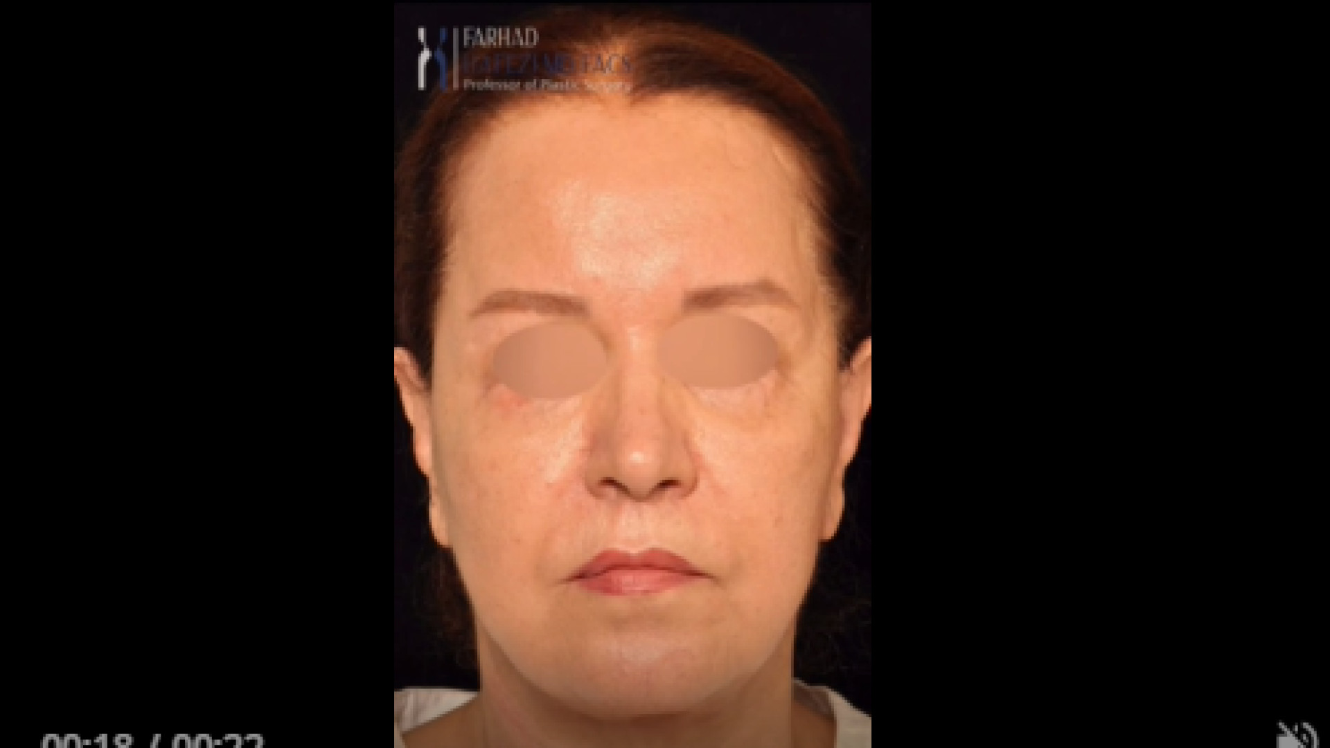 نتیجه لیفت پیشانی و پلک و سانترال لب بالا دکتر فرهاد حافظی