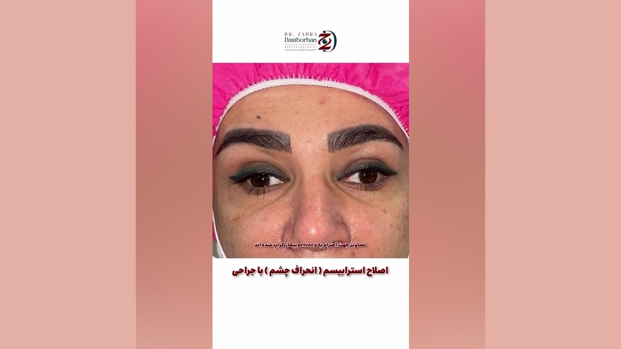 نتیجه جراحی استرابیسم و اصلاح انحراف چشم | جراحی تخصصی توسط دکتر زهرا دست برهان الکترود اپتوژنزی