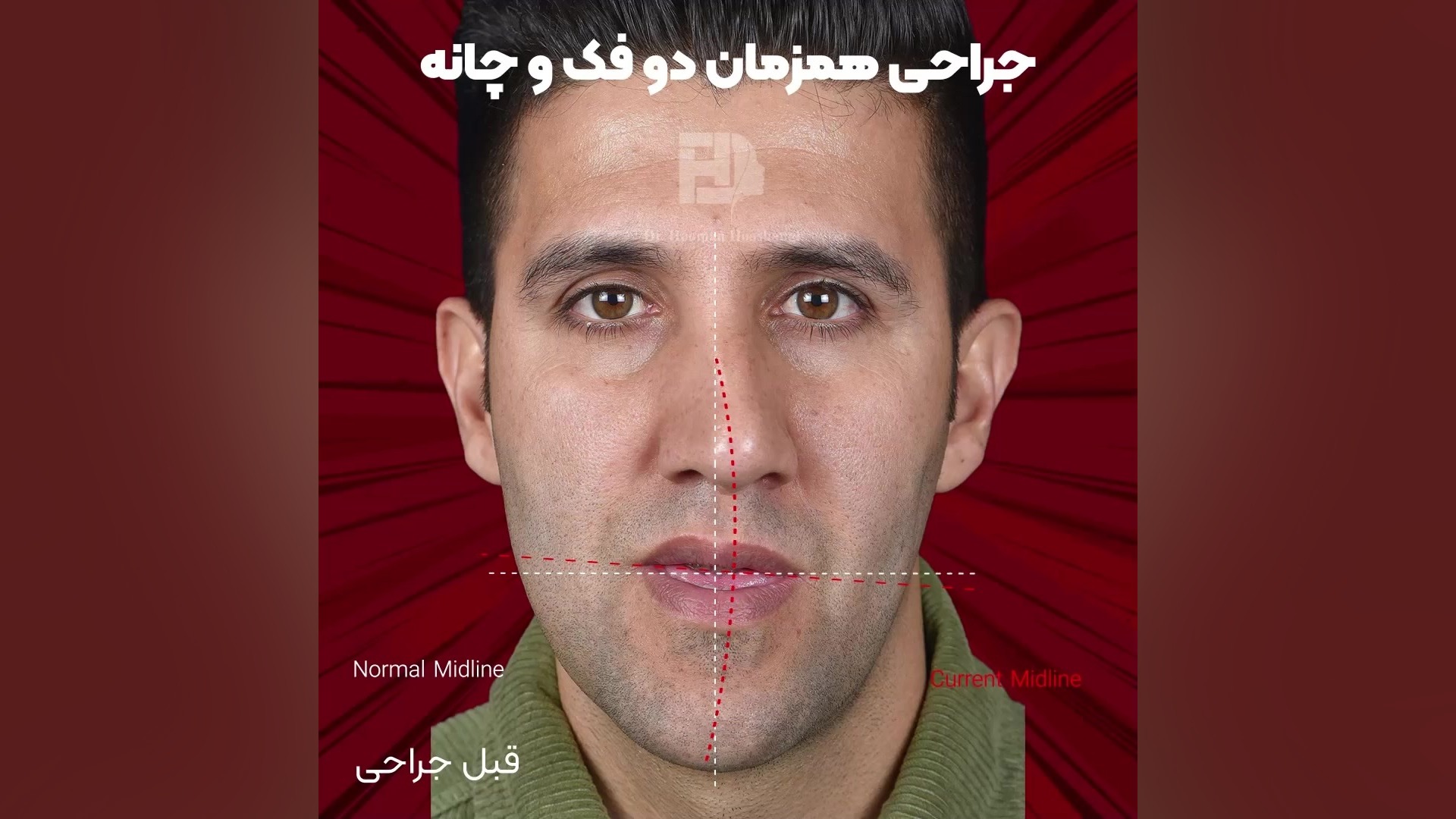 قبل و بعد از جراحی فک و صورت Anti-CCP