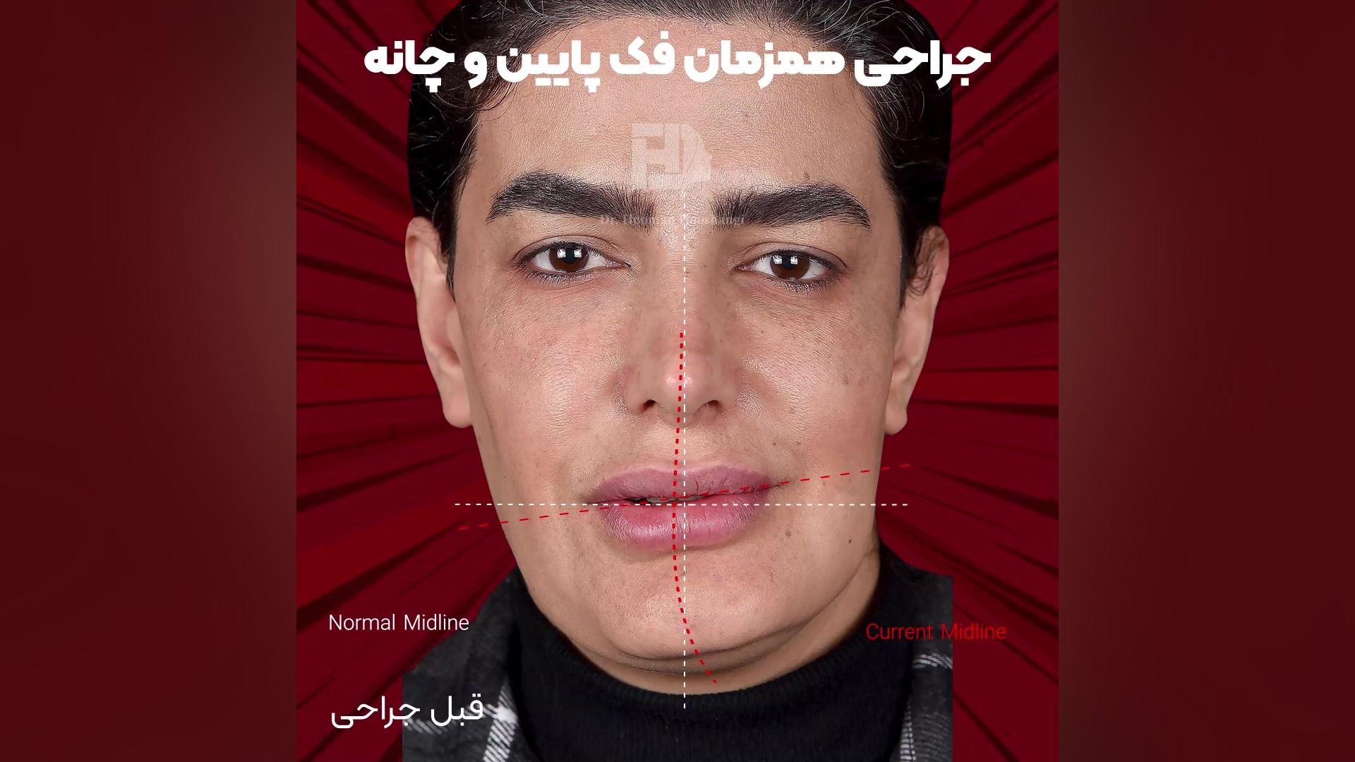 قبل و بعد از جراحی فک ترلتینیب