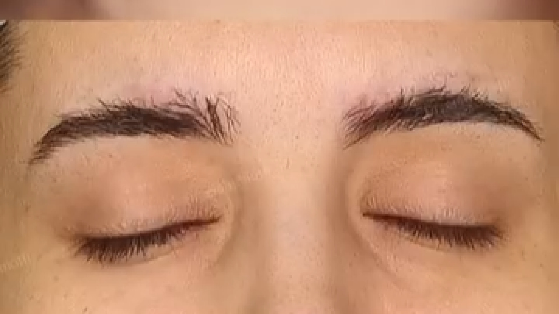 پاک کردن تتو ابرو PVRژنتیک پزشکی پیشرفته