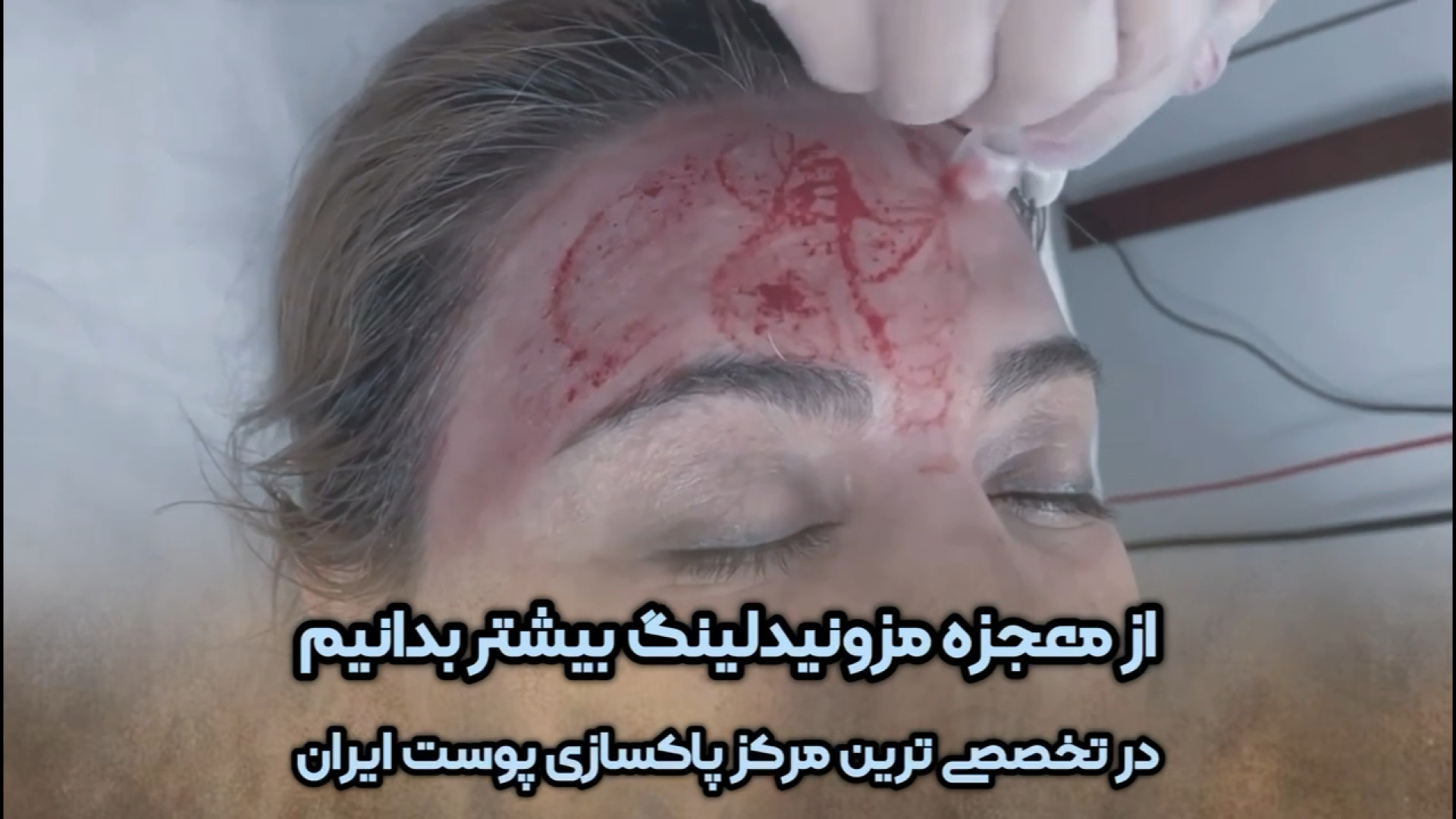 معجزه مزونیدلینگ (پاکسازی پوست) در کلینیک آفتاب انسریدا