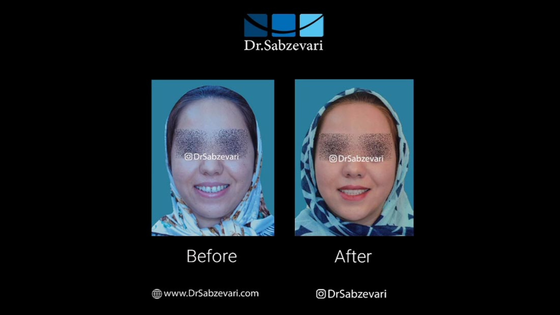 ارتودنسی ثابت دو فک بدون کشیدن دندان دایمی دکتر برهمن سبزواری - متخصص ارتودنسی - مشهد