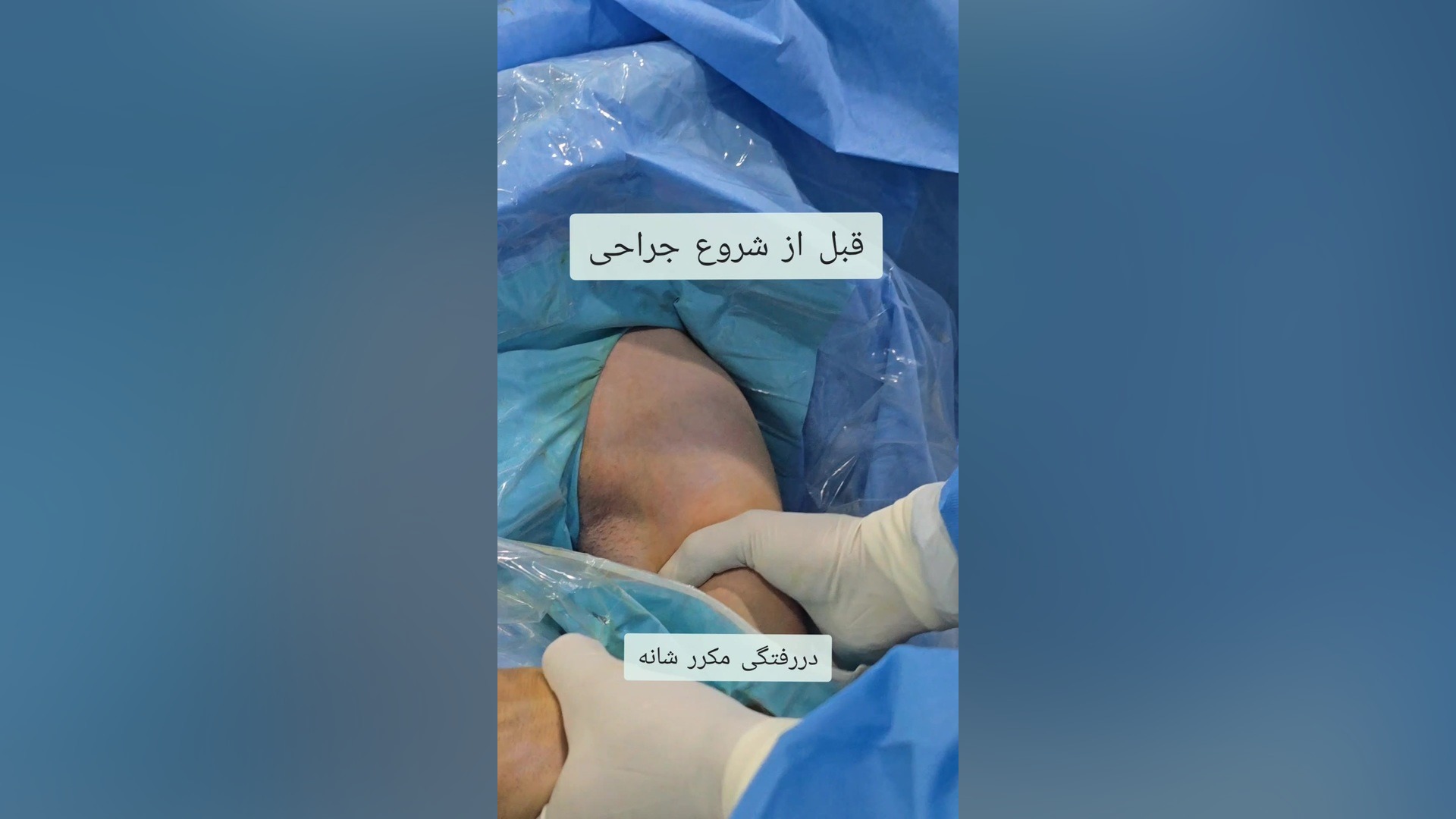 جراحی دررفتگی مکرر شانه با آرتروسکوپی شانه در کرمانشاه دکتر نادر بهرامی چای خور چای
